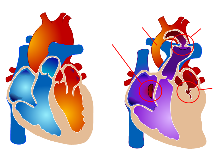 LadyofHats - Drawing Hypoplastic left heart syndrome - no labels